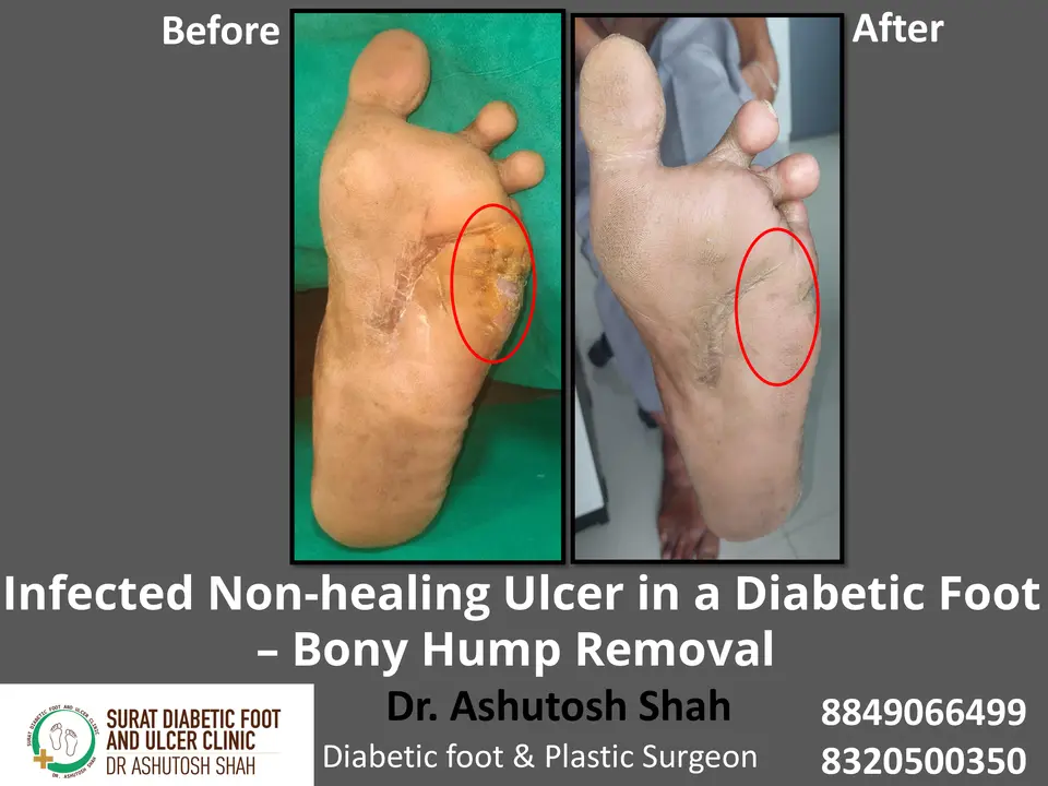 Diabetic Foot  PPT 3 checked by sir.pptx-1.webp